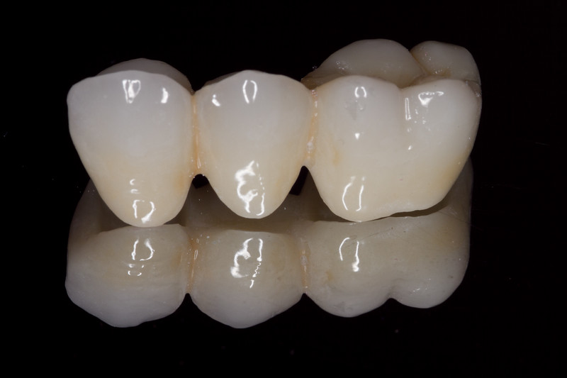 â € œdental zirconia bridgeâ € 